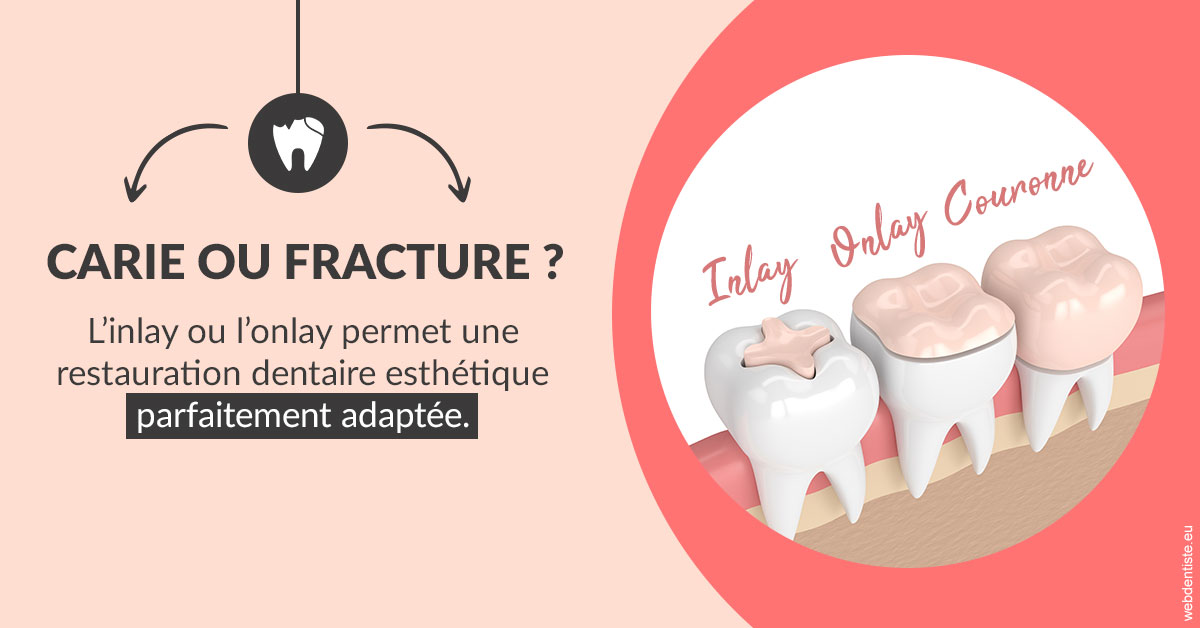 https://www.dentiste-thomas-brossard.fr/T2 2023 - Carie ou fracture 2