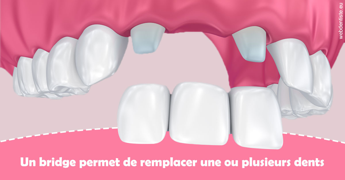 https://www.dentiste-thomas-brossard.fr/Bridge remplacer dents 2