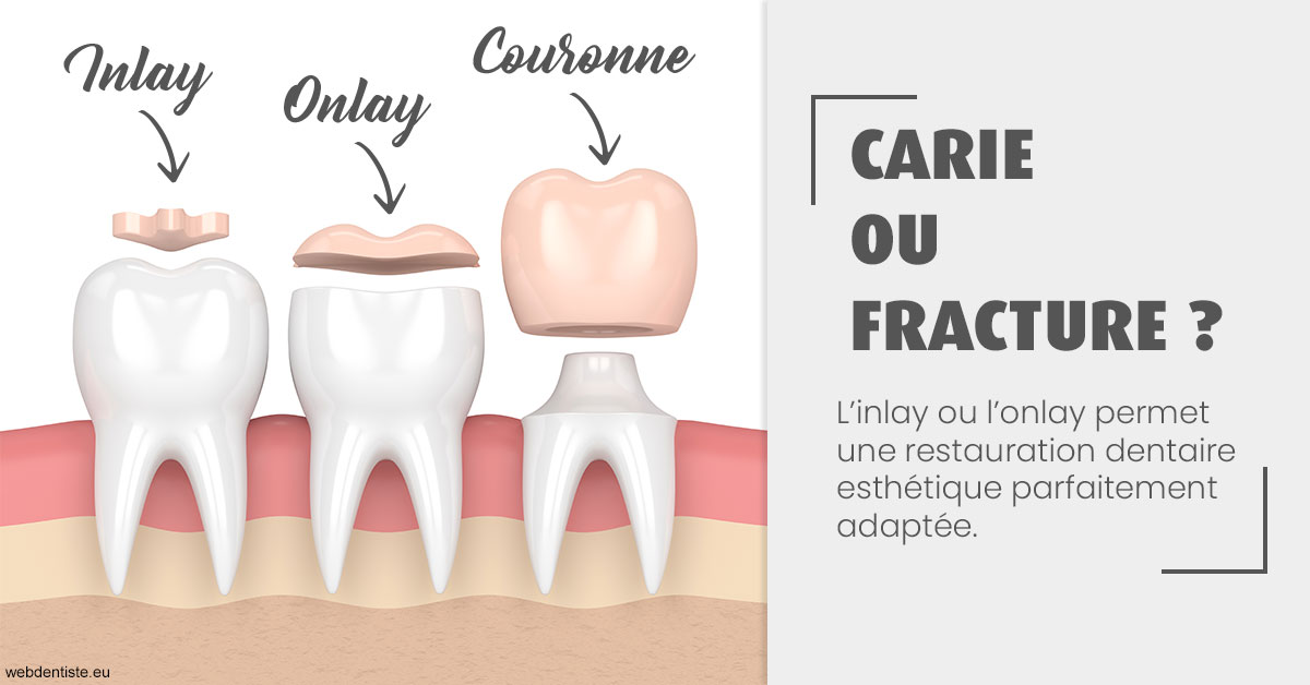 https://www.dentiste-thomas-brossard.fr/T2 2023 - Carie ou fracture 1