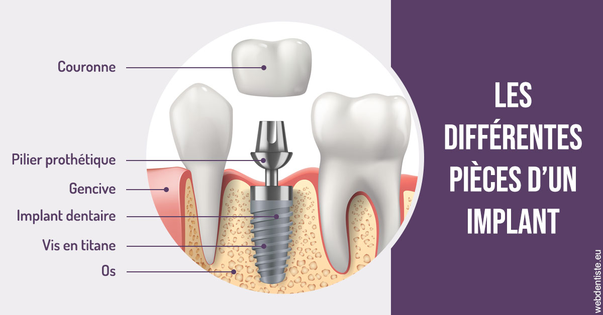 https://www.dentiste-thomas-brossard.fr/Les différentes pièces d’un implant 2