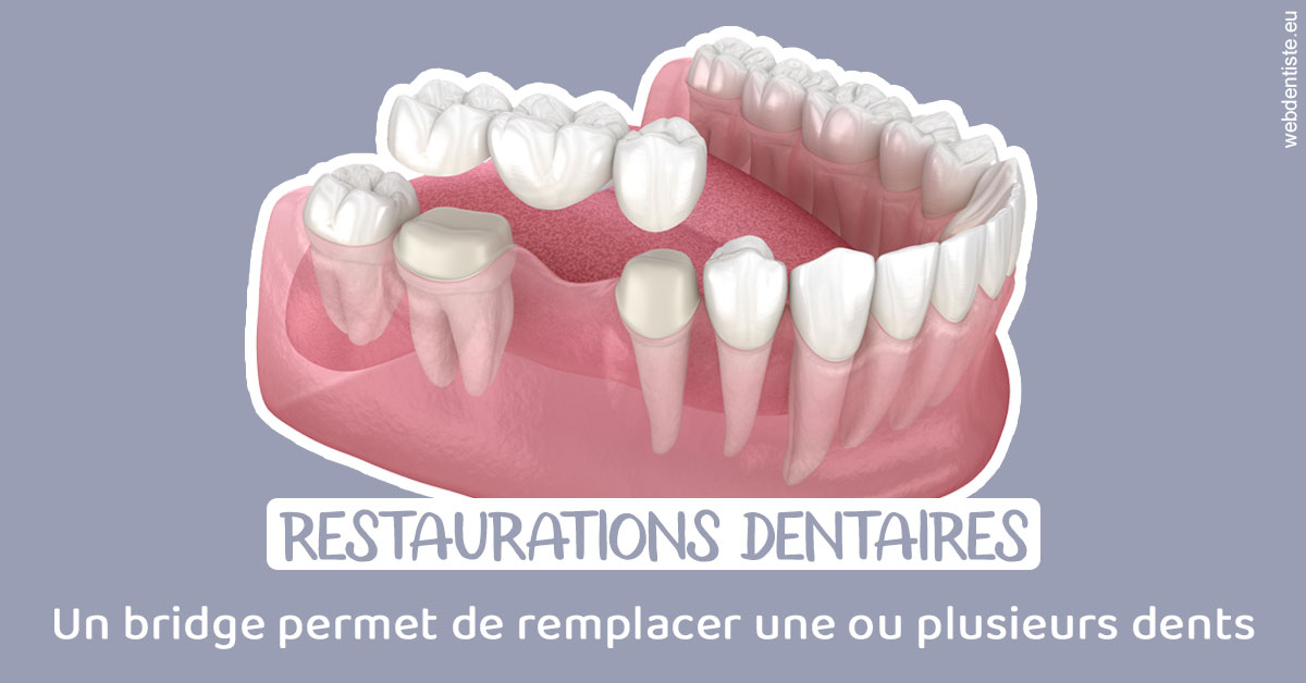https://www.dentiste-thomas-brossard.fr/Bridge remplacer dents 1