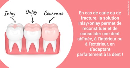https://www.dentiste-thomas-brossard.fr/L'INLAY ou l'ONLAY 2