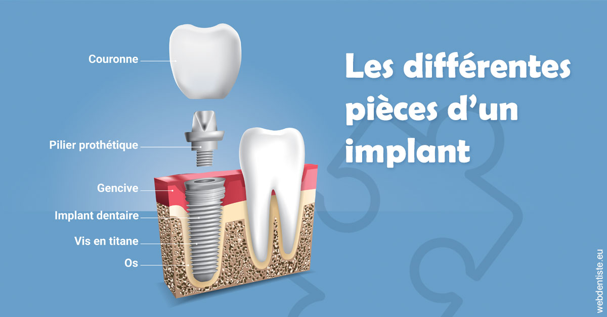 https://www.dentiste-thomas-brossard.fr/Les différentes pièces d’un implant 1