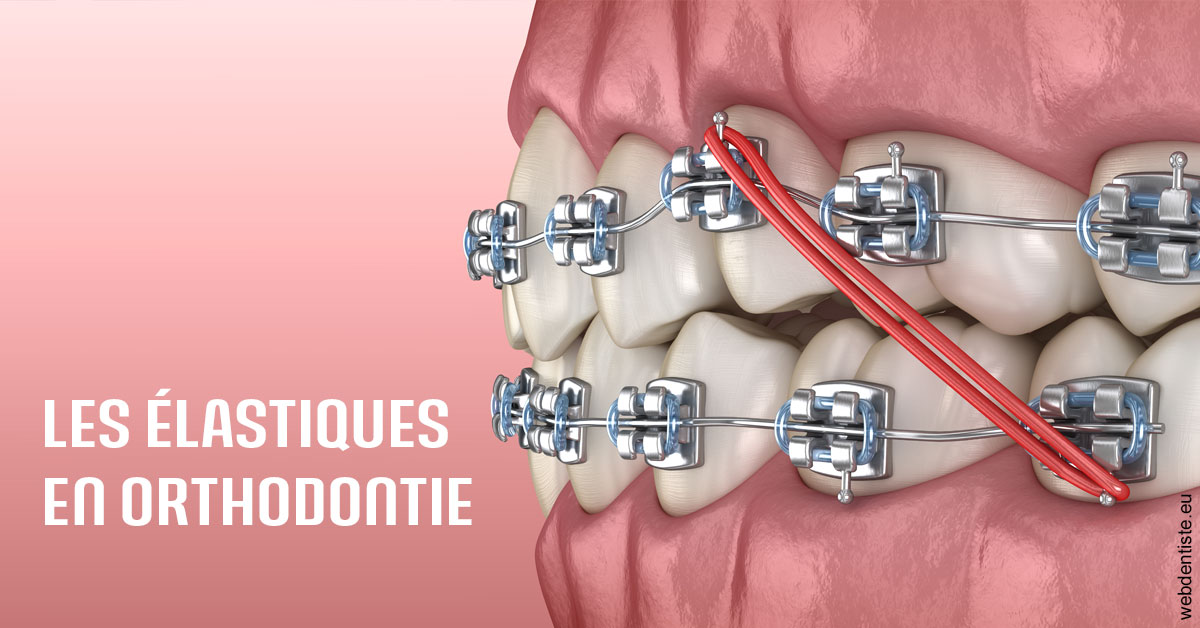 https://www.dentiste-thomas-brossard.fr/Elastiques orthodontie 2